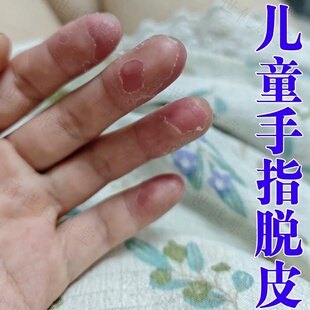 儿童手指蜕皮过敏膏男士女士角质化真菌感染鹅掌风手指爆皮外用药
