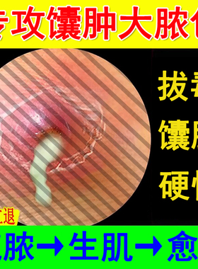 火疖子药膏拔脓毒膏硬块红包痘痘屁股坐板疮疖子大浓包吸脓贴神器