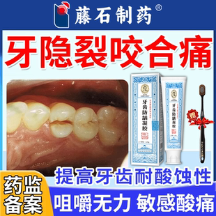 牙隐裂修牙裂牙釉质损伤复磨损脱矿发白咬合痛无力敏感酸痛膏PG
