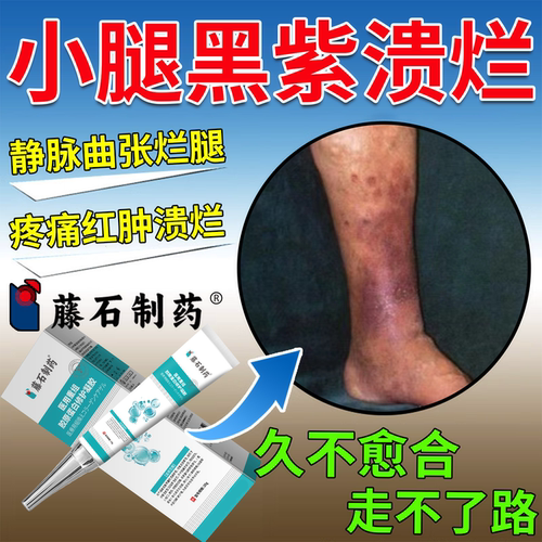 小腿下肢静脉曲张老烂腿专伤口愈合外用膏脉管炎发黑溃疡药监备PG