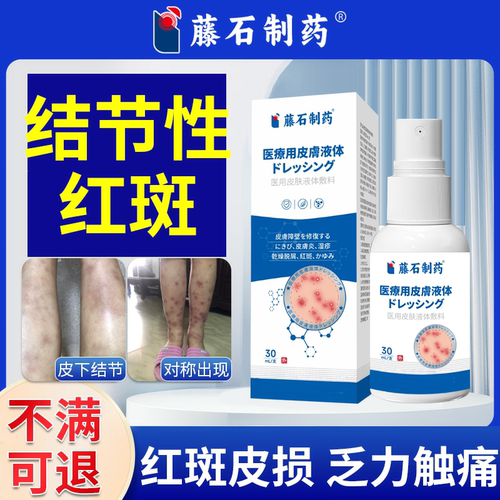结节性红斑痒疹皮肤顽固红硬疙瘩效小腿瘙痒刺痛药监备案PG