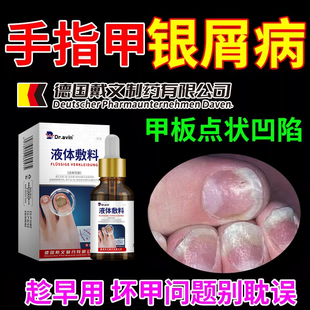 牛皮癣银屑甲病灰指甲变白增厚手指甲真菌感染空甲脱药房同售PG