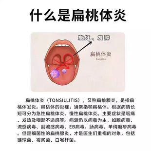 化脓性扁桃体炎扁桃体发炎喉咙肿痛儿童嗓子疼扁桃体肿大喷剂PG