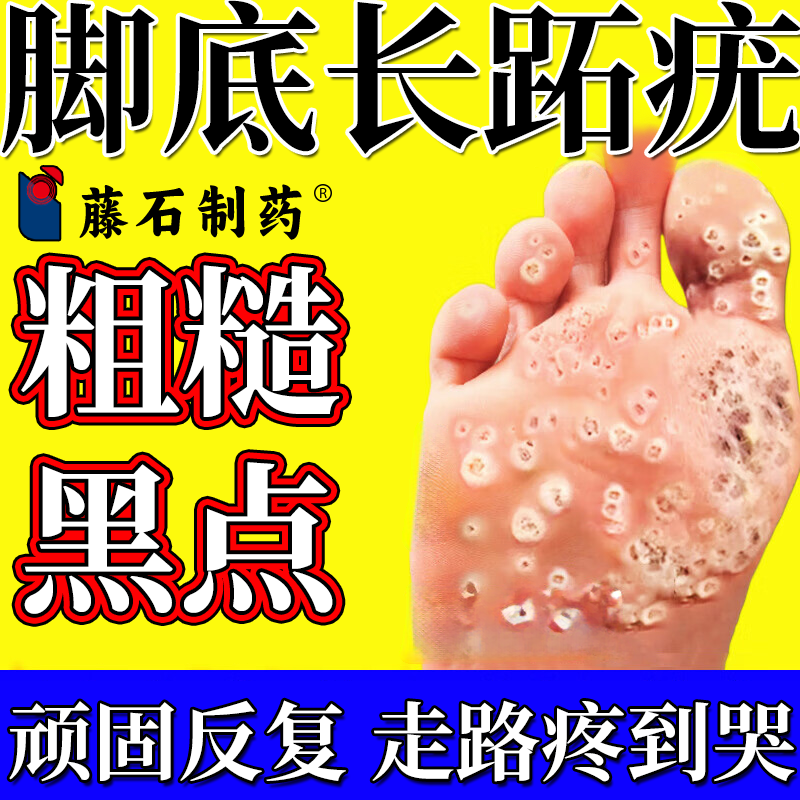 脚底长跖趾疣儿童寻常疣病毒疣鸡眼长肉刺猴子硬疙瘩药监备案PG_虎窝淘
