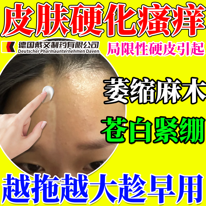 局限性硬皮病软膏硬皮症软化皮肤增厚萎缩手指硬皮癣药房同售PG