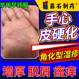 手癣膏角化型湿疹真菌感染鹅掌风脱皮干裂手心粗糙瘙痒药监备案PG