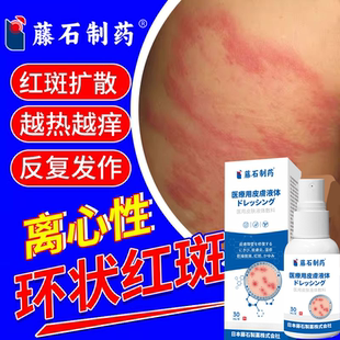 离心性环形红斑环状红斑丘疹瘙痒药房同售圆圈癣血管性荨麻疹膏PG
