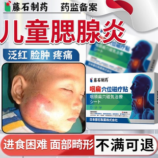 儿童腮腺炎贴淋巴结肿大泛红疼痛脸肿进食困难影响睡眠PG