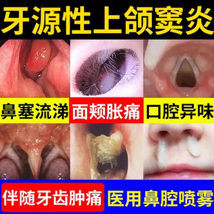 牙源性上颌窦炎鼻窦炎专鼻塞鼻炎鼻涕倒流喷雾剂头疼药监备案PG
