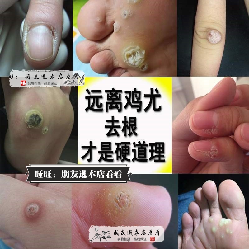 跎疣甲周疣手部去脚上刺猴子寻药膏足底疣除肉瘊子膏
