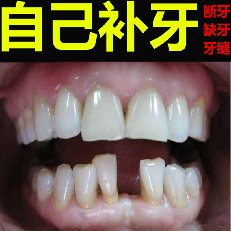 补门牙效果图,补门牙(第4页)_大山谷图库