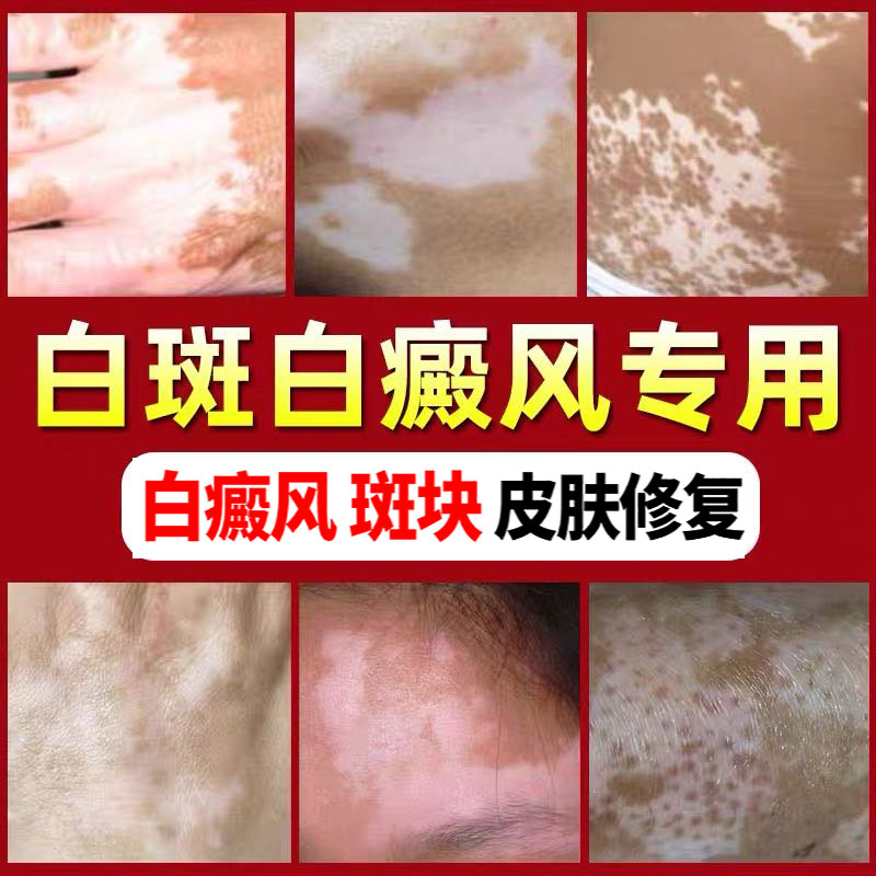 白癜风外用药促黑色素修复遮盖补骨脂酊治喷剂白斑净汗斑专用克星