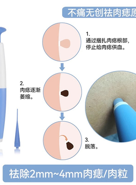 Tagband Skin Tag Removal Tool祛皮赘笔祛肉痣祛鸡眼祛疣器除疣