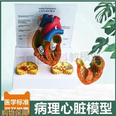 病理心脏模型颤动心房临床医患沟通人体心脏解剖瓣膜冠状动脉心室