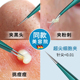 德国细胞夹黑头超细粉刺夹超尖黑头夹镊子刮去闭口美容院专用工具