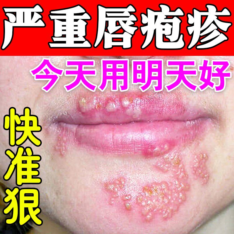 冬天上火嘴巴起小水泡嘴唇单纯疱疹修复烂嘴角糜烂红肿痒疼专用膏