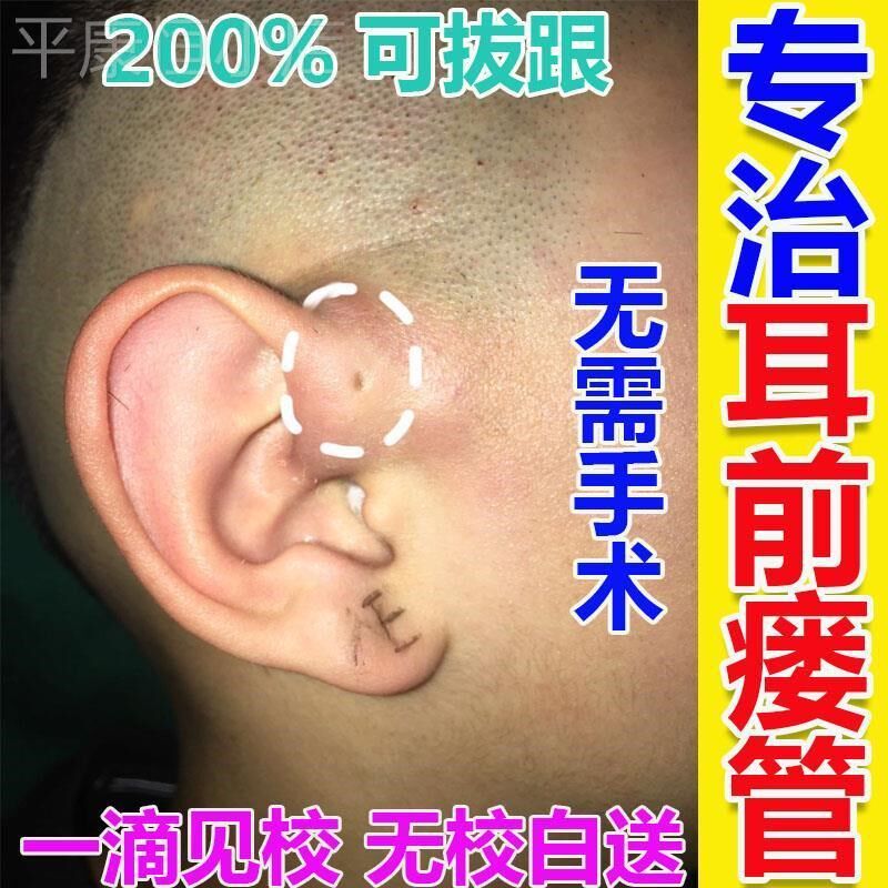 治疗耳前瘘管药膏耳仓发炎流脓红肿疼痛鼓包异味中耳炎专用滴耳液