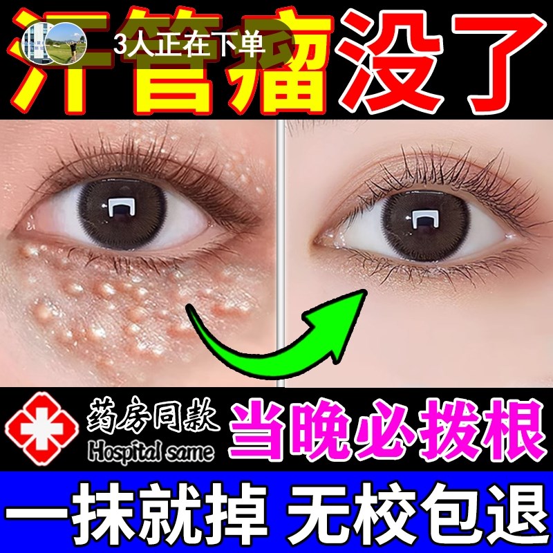 汗管瘤眼部去除神器水油脂粒祛眼周颗粒眼脸黄瘤消除眼霜专用膏