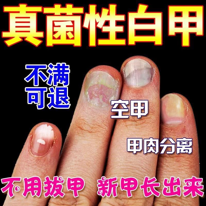 脚指甲发黄变厚增厚变黄变硬真菌白甲空甲修复甲分离脱落软化神器