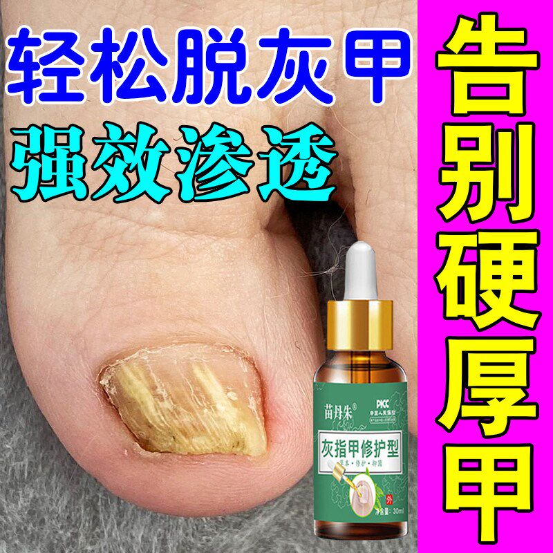 脚指甲发黄变厚分层真菌性白甲空甲床分离修护黄黑白空甲坏甲增厚