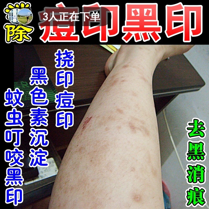 疤痕烫伤去黑印色素沉淀淡化蚊虫叮咬去黑印疤印抓痕修复按摩乳膏