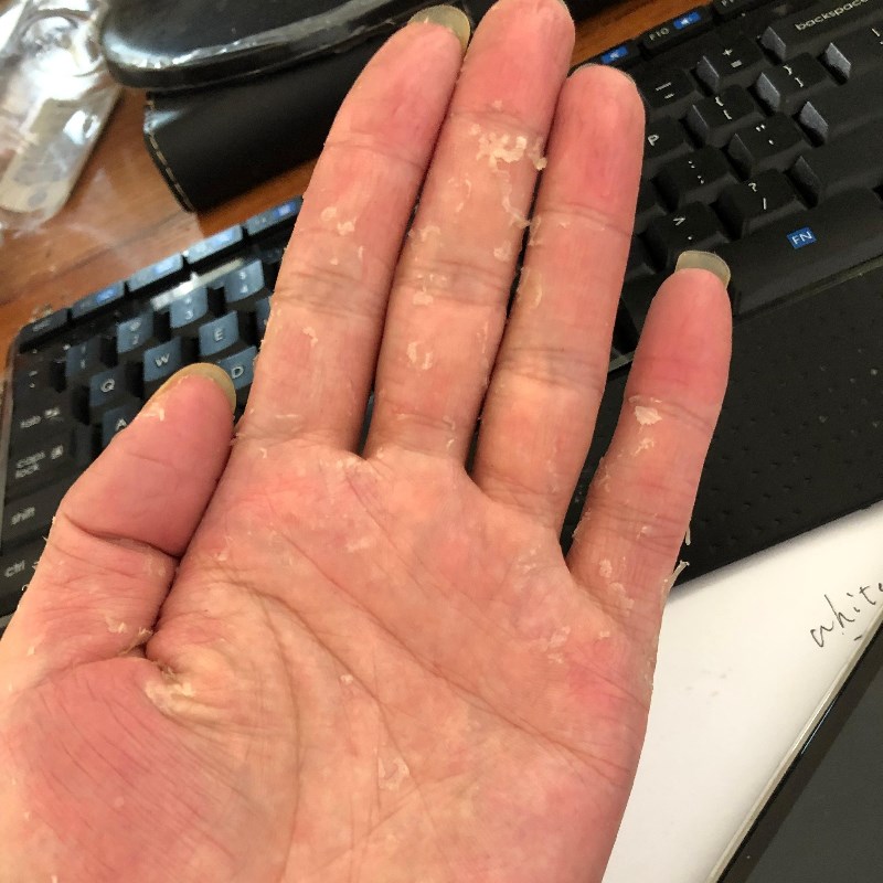手癣手脱皮干裂汗泡疹足藓鹅掌风手上起小水泡手痒真菌感染痒膏