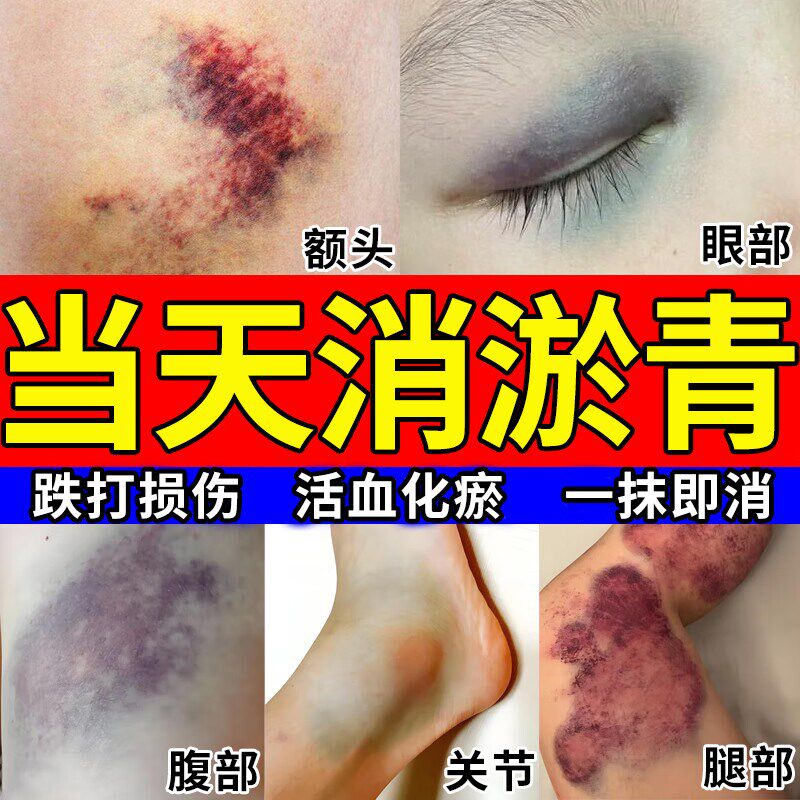 淤青快速消除活血化瘀外用膏婴儿摔扭撞伤发紫通经络消肿舒缓药膏