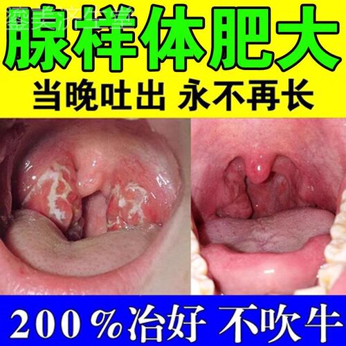 【不用手术可冶愈】腺样体肥大童面容矫正器张嘴打鼾中药调理贴