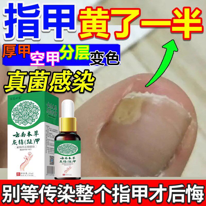 脚指甲发黄变厚增厚变黄变硬真菌白甲空甲修复甲分离脱落软化神器