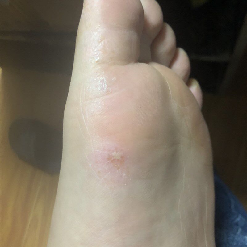脚趾缝起小水泡起皮脱皮脚底板粗糙干裂发红温和滋润烂脚丫软膏
