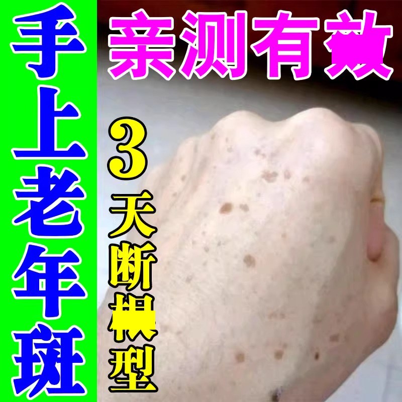 老年斑强力去除手上雀斑手背手部晒斑黑班黄褐斑点斑水斑霜专用