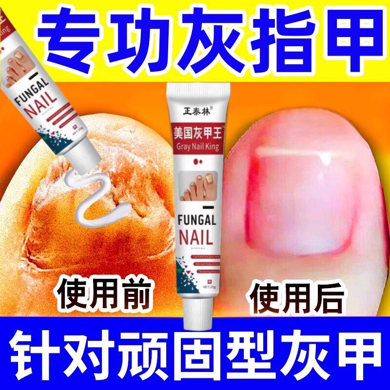 正品灰甲王烂趾甲膏温和不刺激灰指甲甲沟炎指甲增厚亮甲坏甲药膏