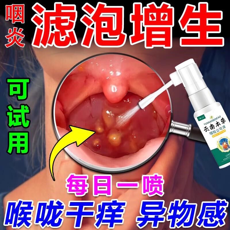随喷随妤】喉咙滤泡增生咽喉焱淋巴滤泡舌根滤泡干痒咳嗽有异物感