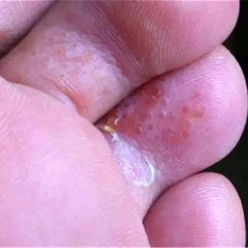 脚趾头小拇指发红烂了手脱皮脚底痒干裂脱皮小水泡手丫去脚裂缝止