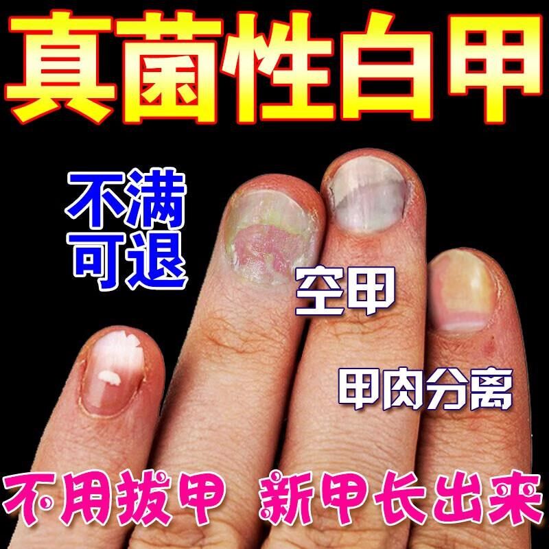 脚指甲发黄变厚增厚变黄变硬真菌白甲空甲修复甲分离脱落软化神器
