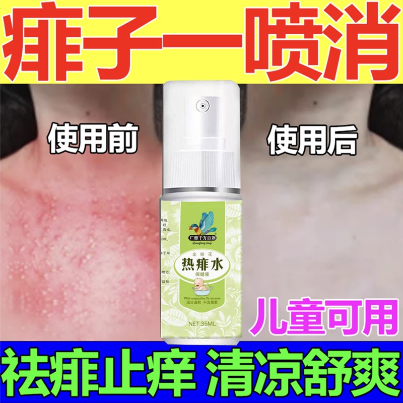 【1喷痱】热痱水宝宝成人痱子粉热痱子水喷雾