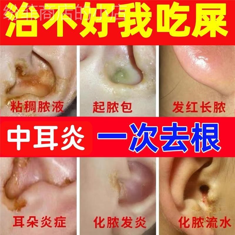 用中耳专用外耳道红止痒滴耳液流水流脓采耳油耳朵痒湿药软膏炎人