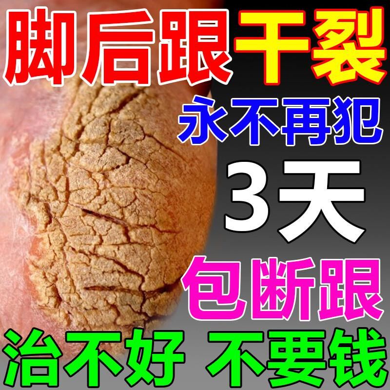 治脚裂脚后跟足跟干裂开裂皲裂真菌感染去死皮起硬皮脱皮膏修复霜