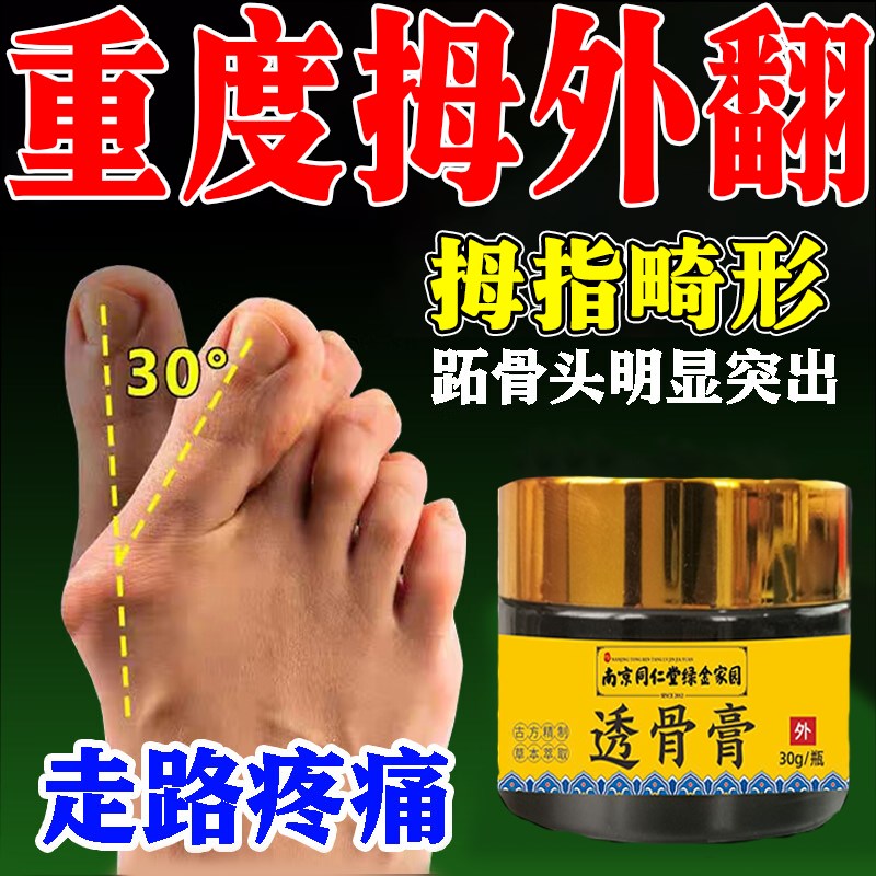 【当晚矫正】矫正器拇外翻大脚骨重叠拇外翻药膏矫正神器