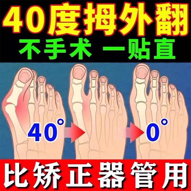 【三天消】拇指外翻贴大脚骨矫正神器脚趾重叠防磨脚趾变形疼痛贴
