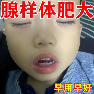 腺样体肥大泡脚中药包张嘴呼吸打呼噜面容矫正器儿童嘴唇上翘克星