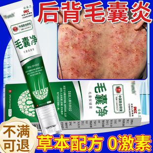 后背前胸长痘痘毛囊炎药膏特马拉色菌疙瘩效头部皮肤瘙痒焱X