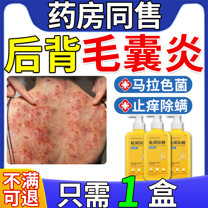 【毛囊炎专用】沐浴露