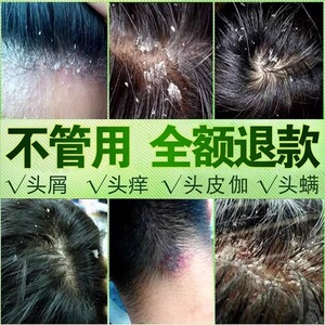 头皮屑严重去头屑洗发水正品去屑止痒中药洗头膏头皮毛囊深层清洁