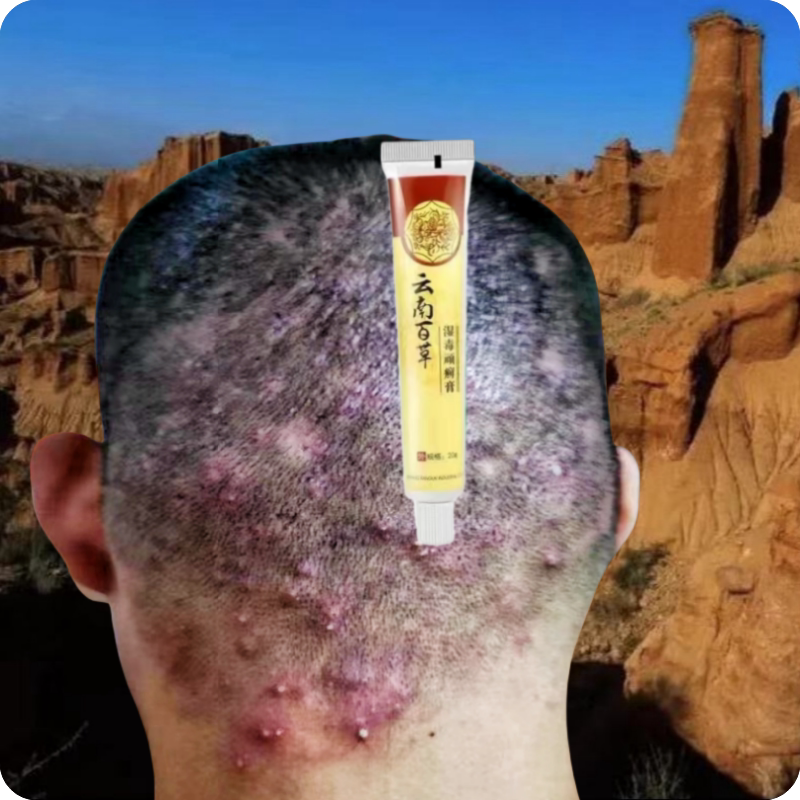 头皮长红疙瘩脓包痘痘头皮痒毛囊炎头上毛囊红肿起脓包后脑勺疙瘩