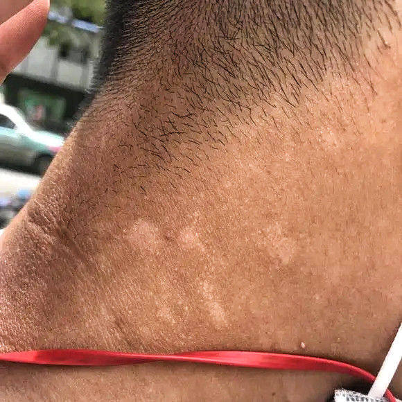 脖子上白斑汗斑花斑癣去汗斑药膏身上多汗脸颊胸口白斑褐斑花斑癣