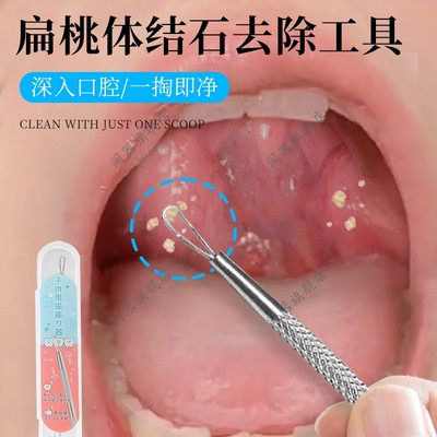 扁桃体结石去除工具取出隐窝神器口腔扁条体扁桃腺扁导体石清理器