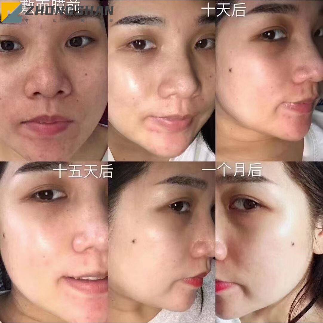 面部祛斑专用药水精华液真皮斑黄褐斑色素分解液排黑排色液溶斑油