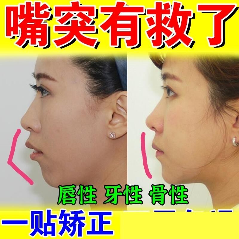 深覆合矫正器成人厚嘴唇外翻夜间凸嘴矫正器变薄变小神器发黑嘴突