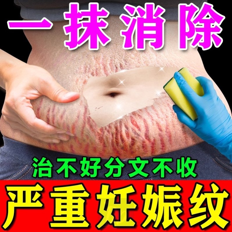 【院线同款】淡纹膏妊娠纹肥胖纹产后修复淡化生长纹红白紧致肚皮